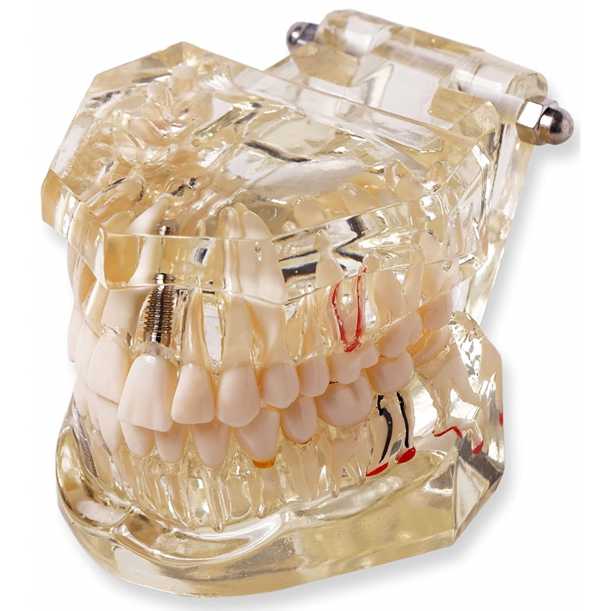 Dental Model For Patient Education With Pathologies To